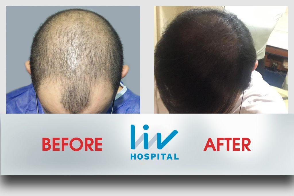 LIV Hospital before and after Hair transplant 4