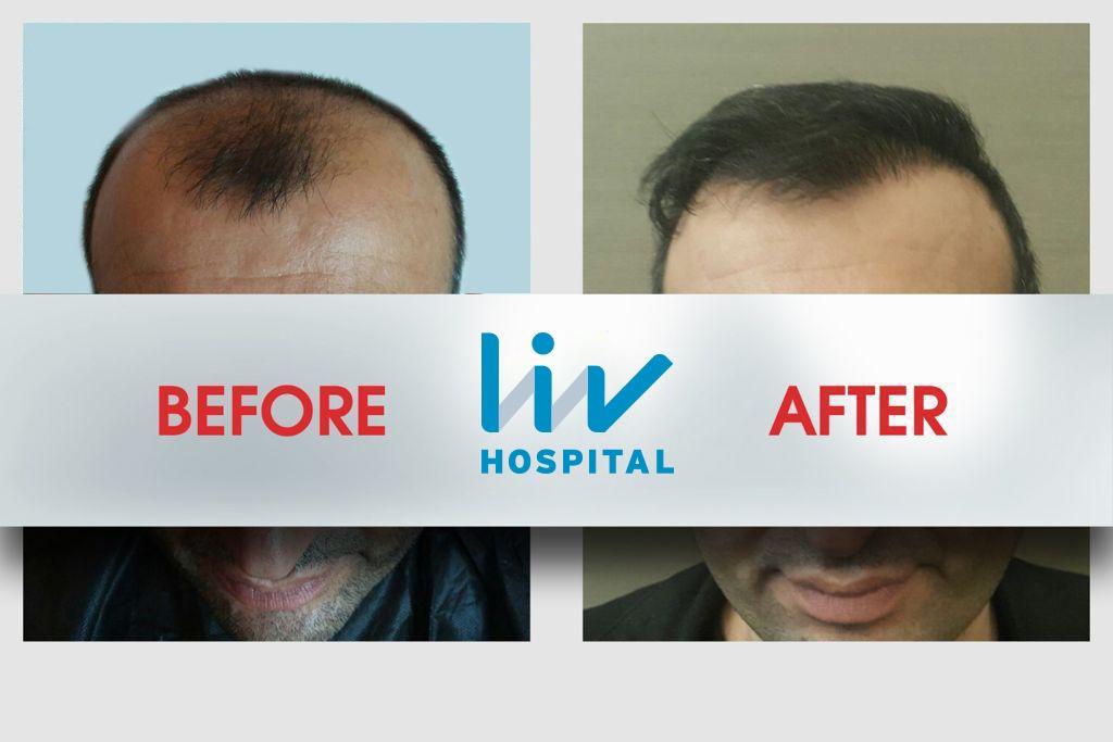 LIV Hospital before and after Hair transplant 5