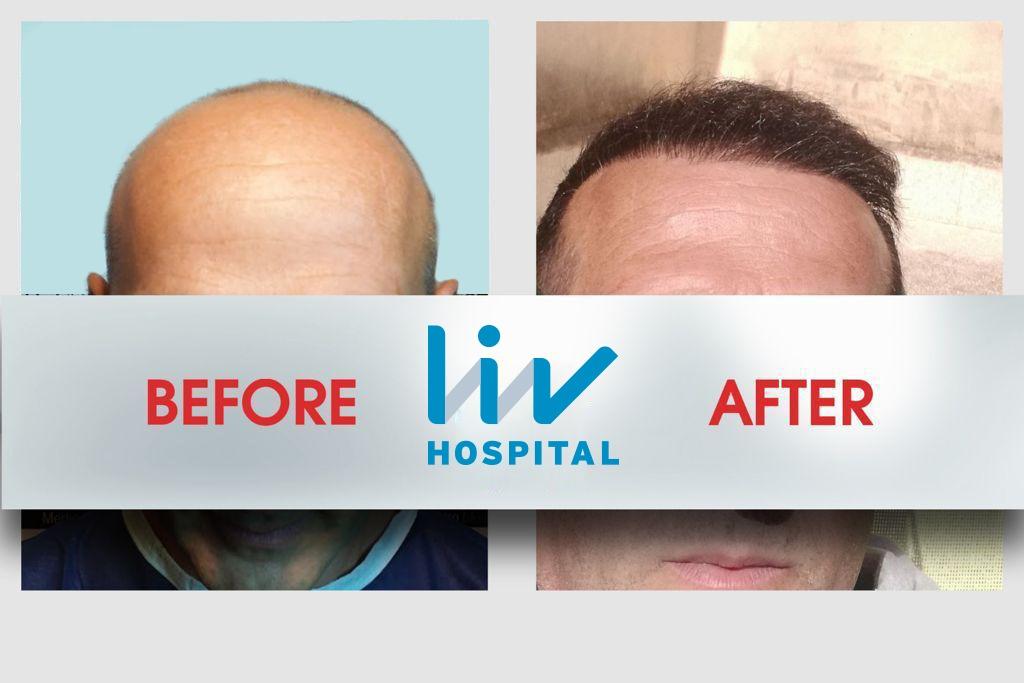 LIV Hospital before and after Hair transplant 6