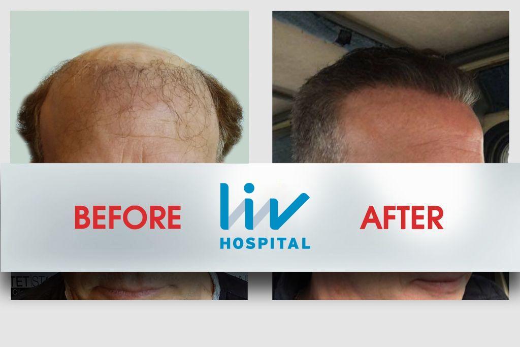 LIV Hospital before and after Hair transplant 7