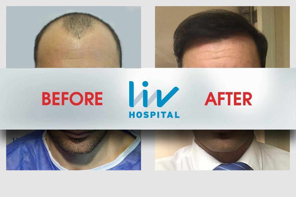 LIV Hospital before and after Hair transplant 8