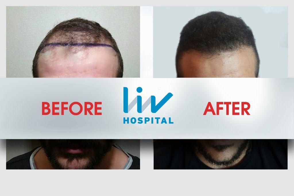 LIV Hospital before and after Hair transplant 10