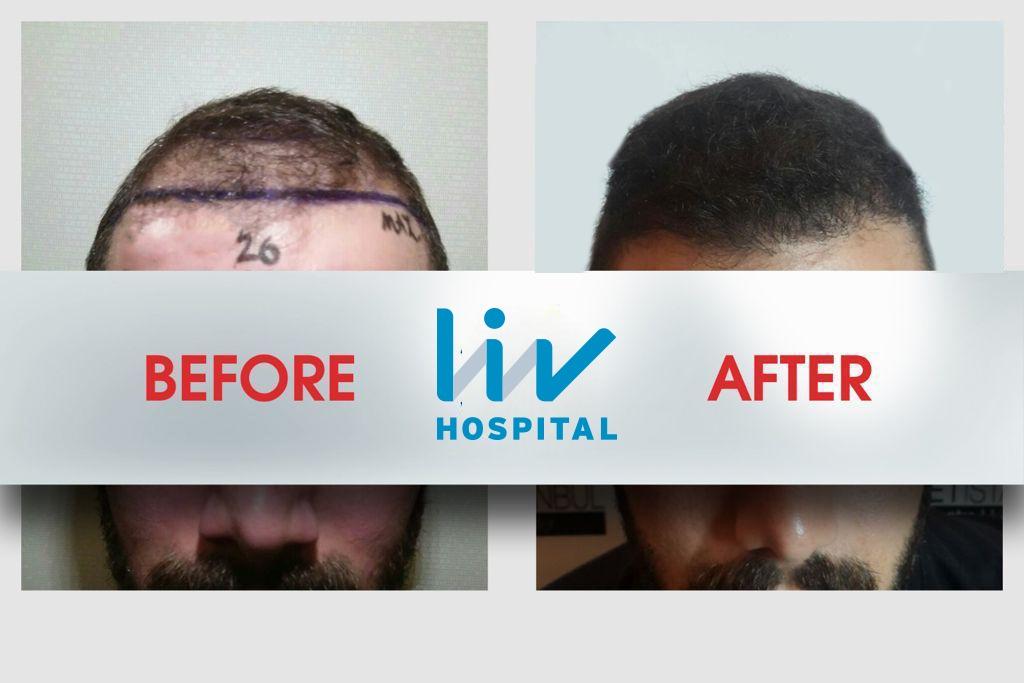 LIV Hospital before and after Hair transplant 11