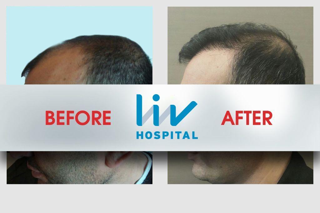 LIV Hospital before and after Hair transplant 12