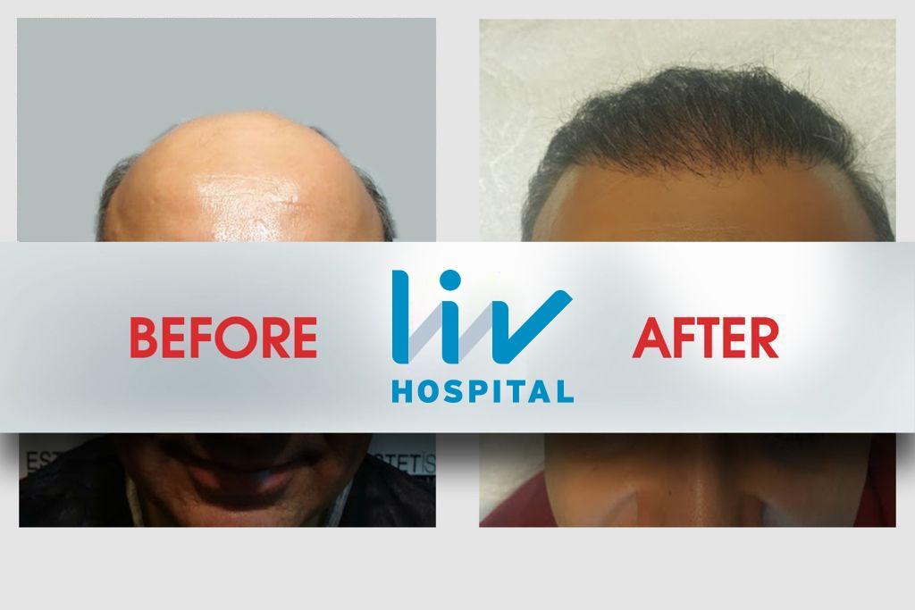 LIV Hospital before and after Hair transplant 13