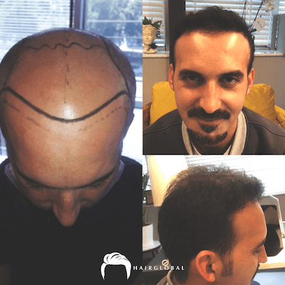 HairGlobal hair results18