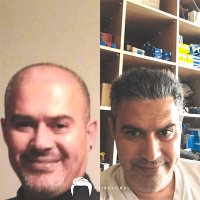 HairGlobal hair results15