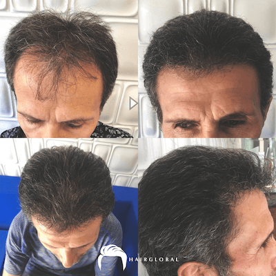 HairGlobal hair results7