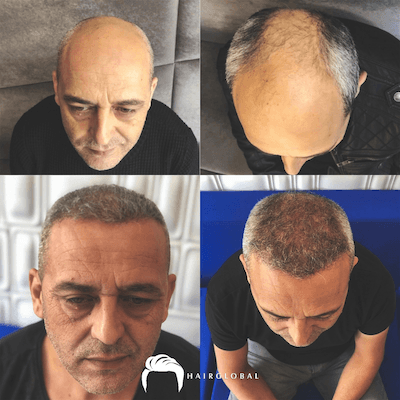 HairGlobal hair results5