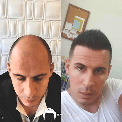 HairGlobal hair results3