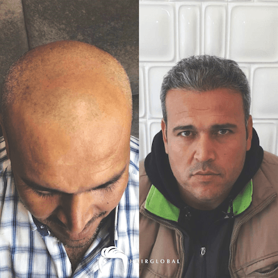 HairGlobal hair results13