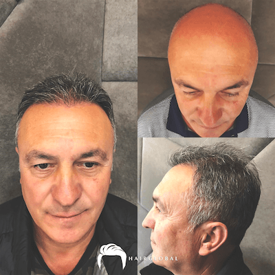HairGlobal hair results11