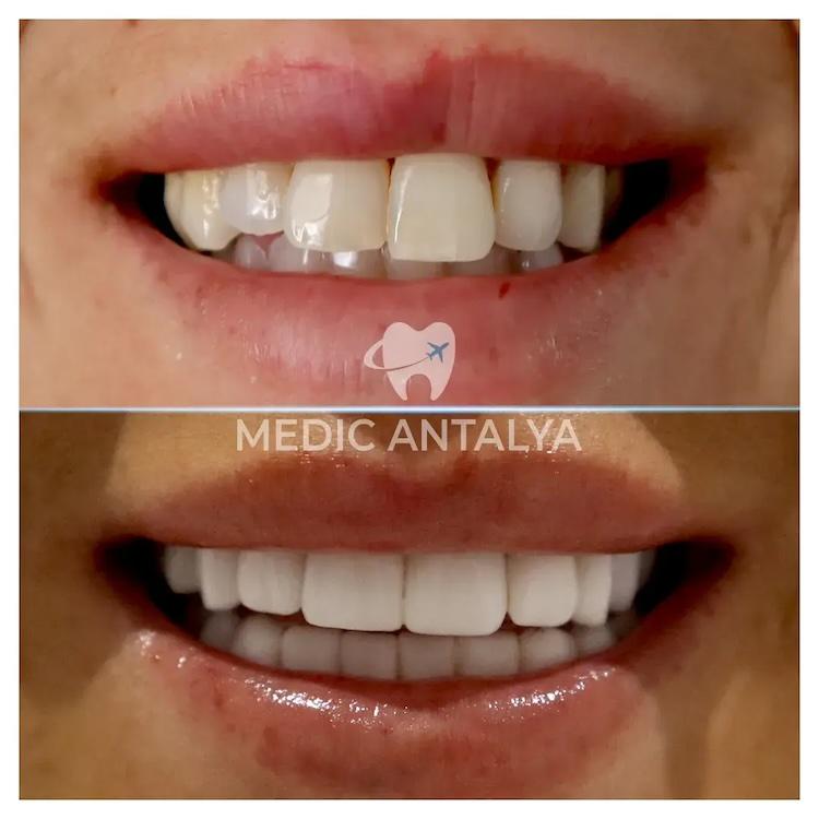 Medic antalya - Dental results6