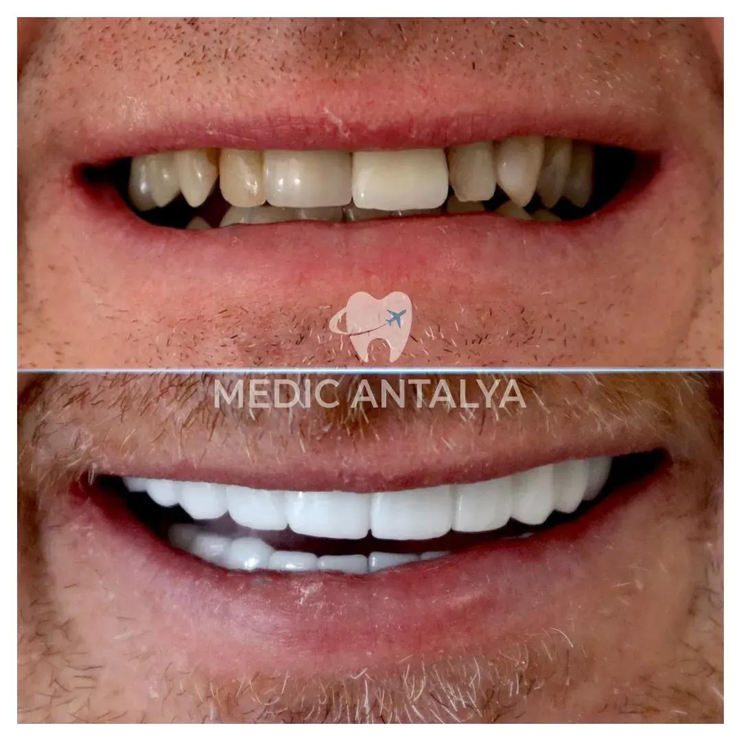 Medic antalya - Dental results8