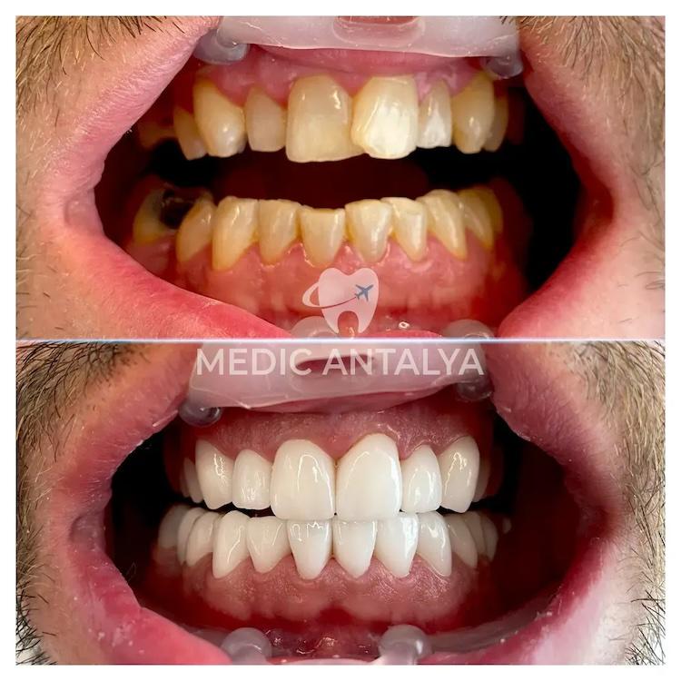 Medic antalya - Dental results13