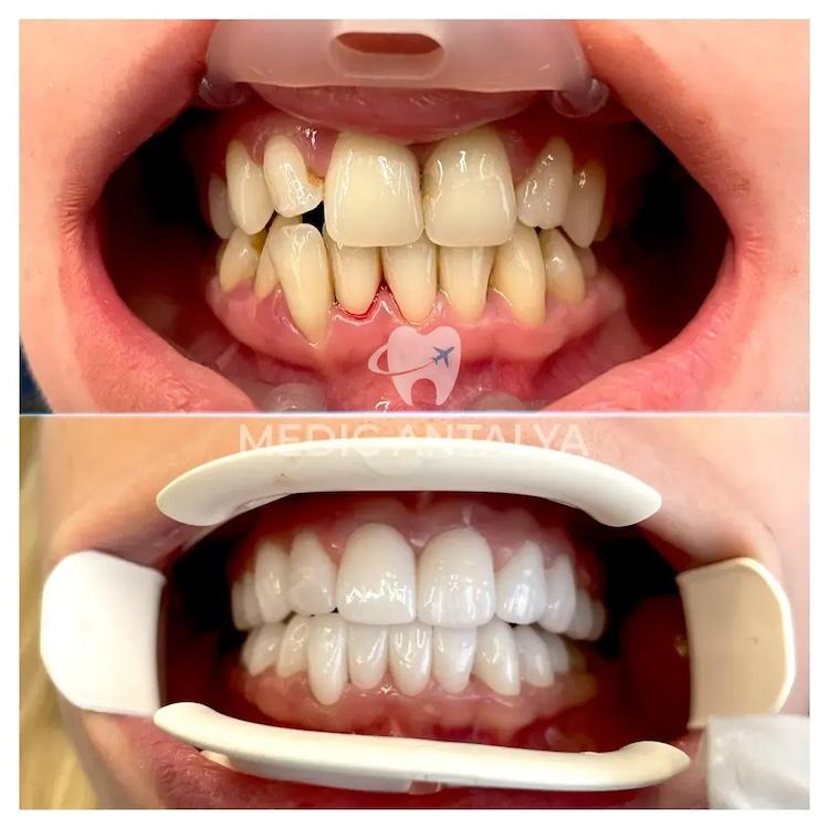 Medic antalya - Dental results15
