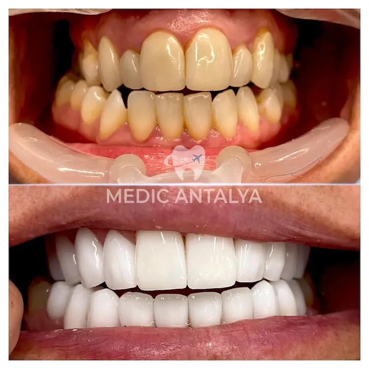Medic antalya - Dental results22