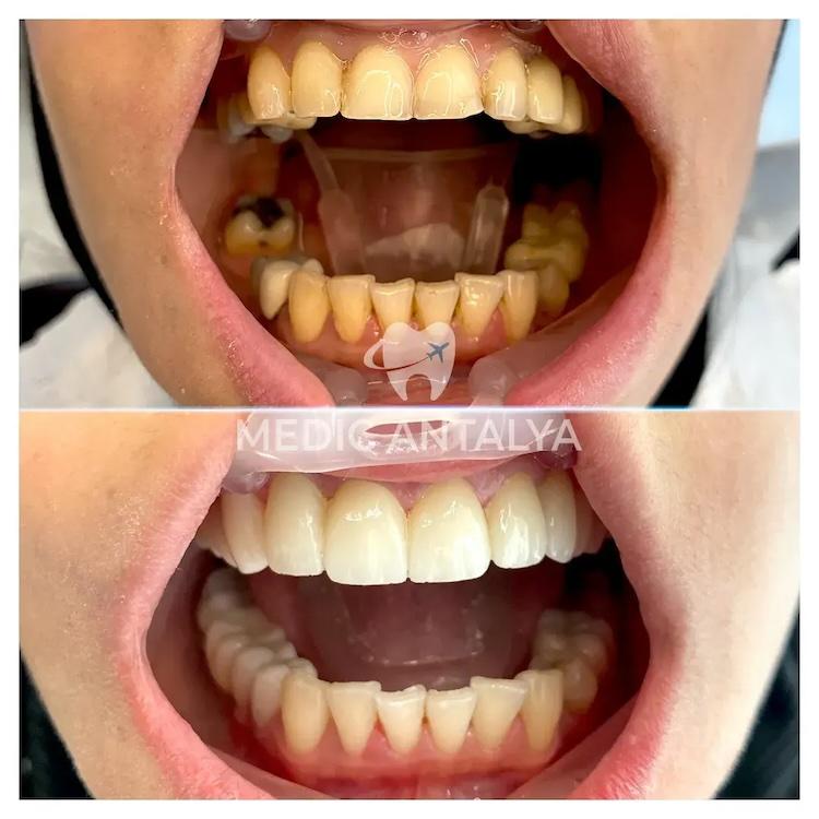 Medic antalya - Dental results25