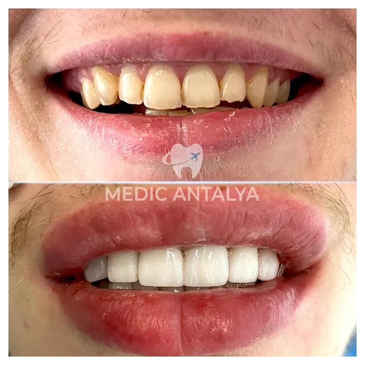 Medic antalya - Dental results26
