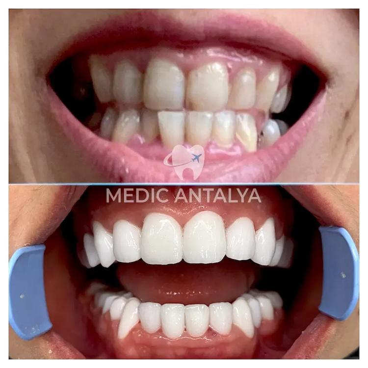 Medic antalya - Dental results27