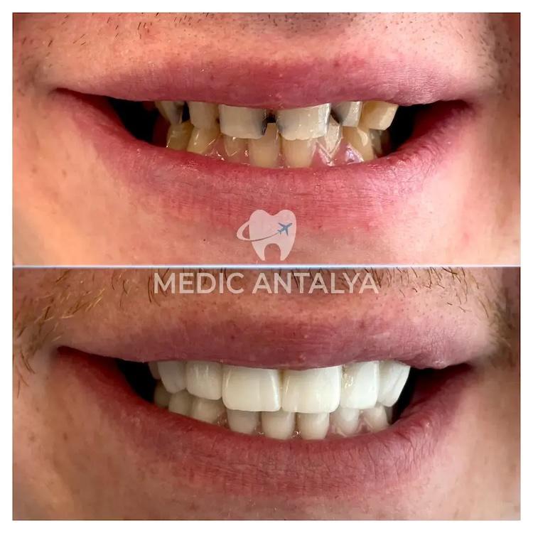 Medic antalya - Dental results28