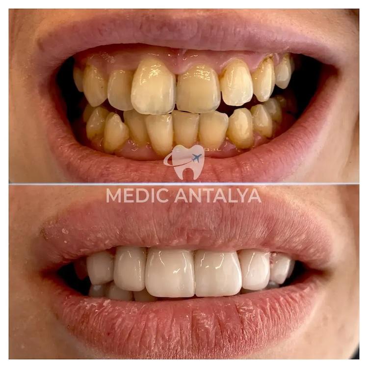 Medic antalya - Dental results29