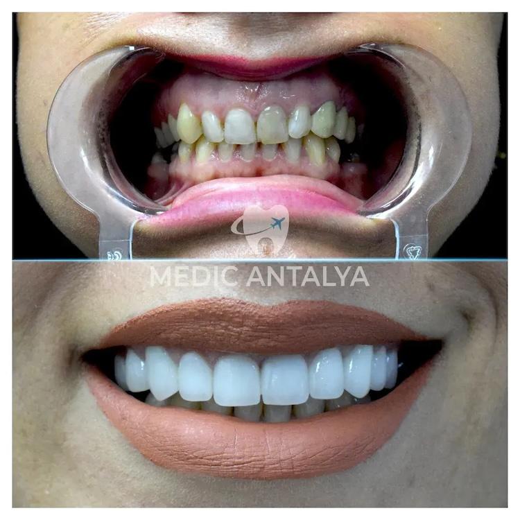 Medic antalya - Dental results33