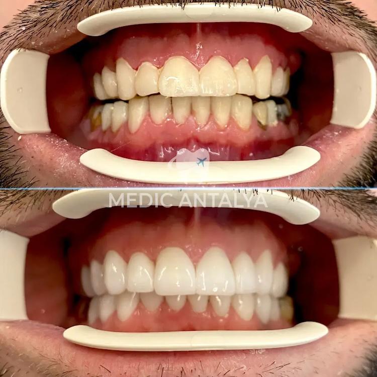 Medic antalya - Dental results34