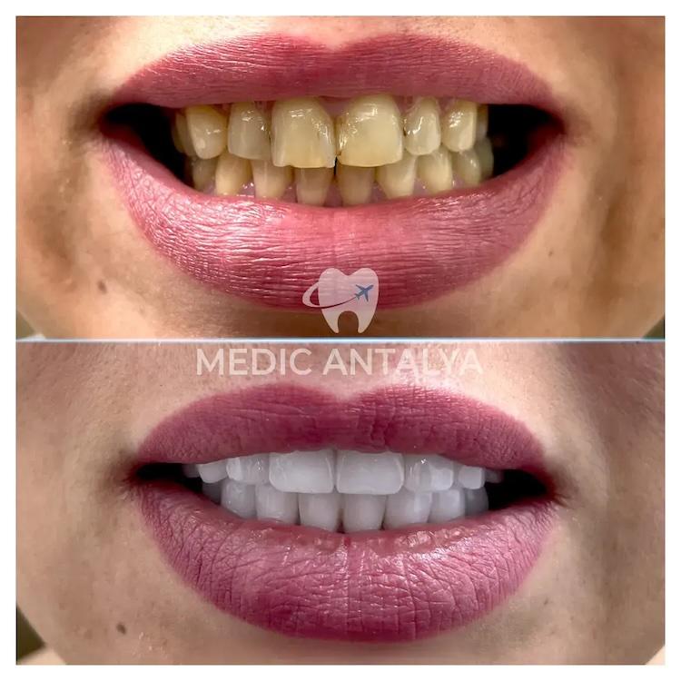 Medic antalya - Dental results35