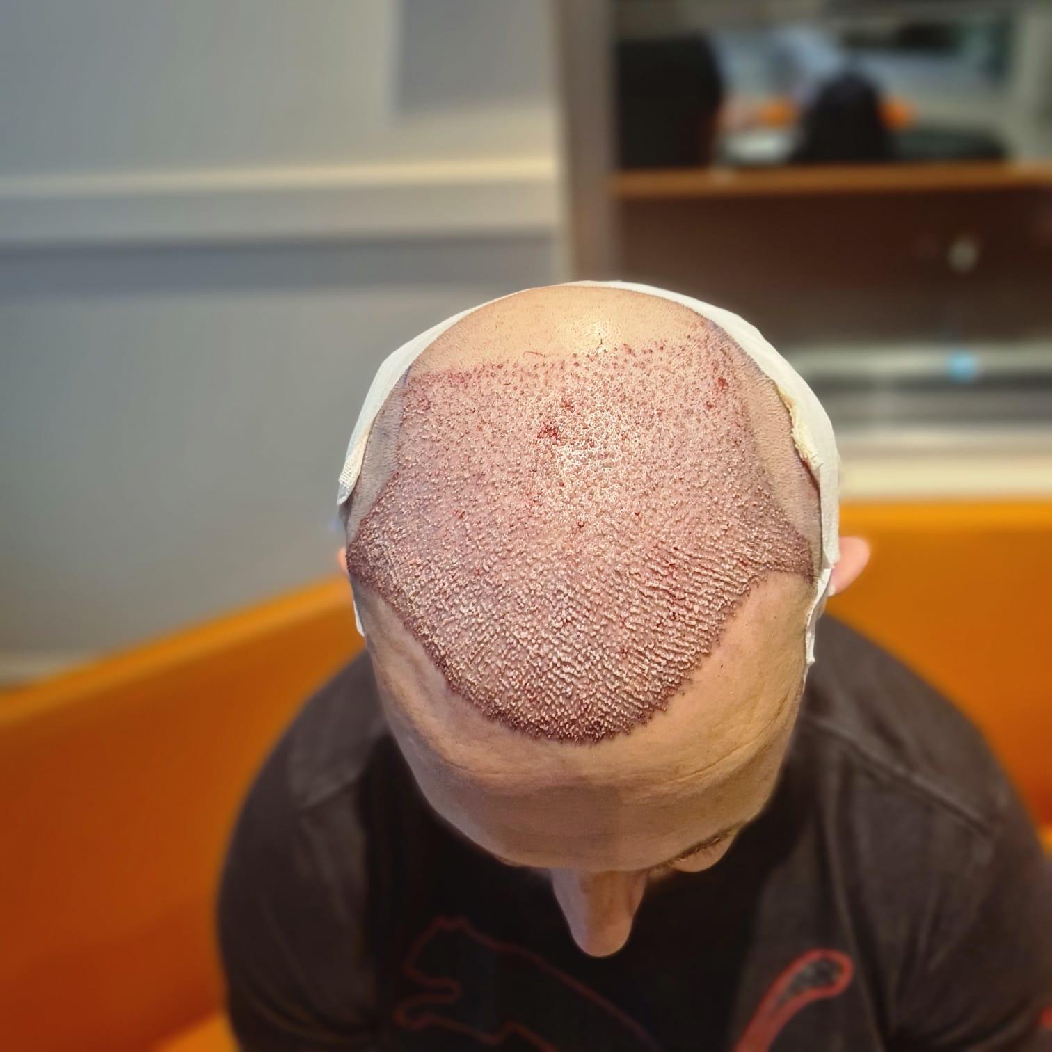 hope hair health - hair transplant results 17