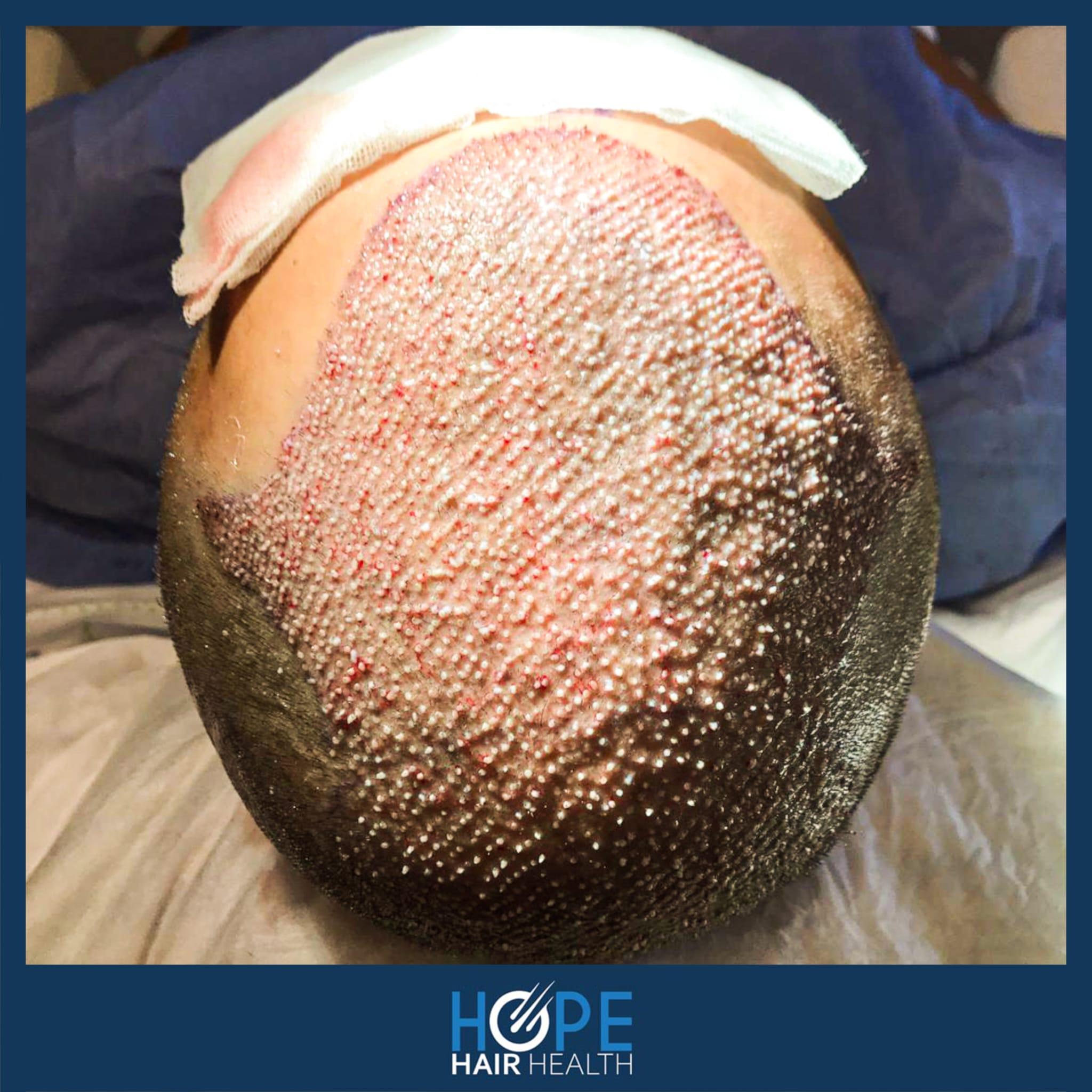 hope hair health - hair transplant results 13