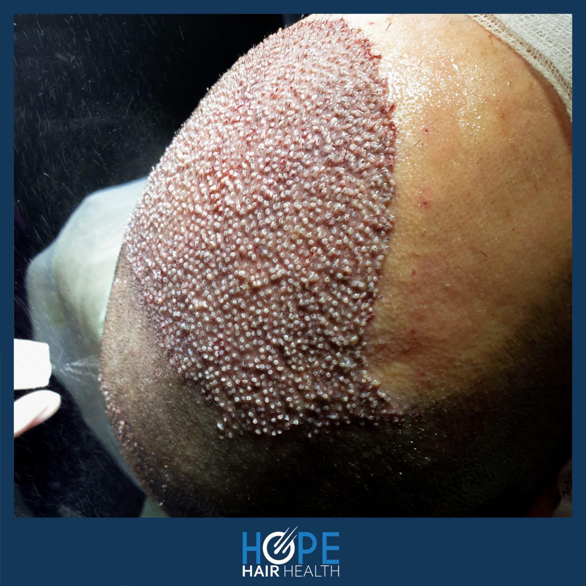 hope hair health - hair transplant results 15