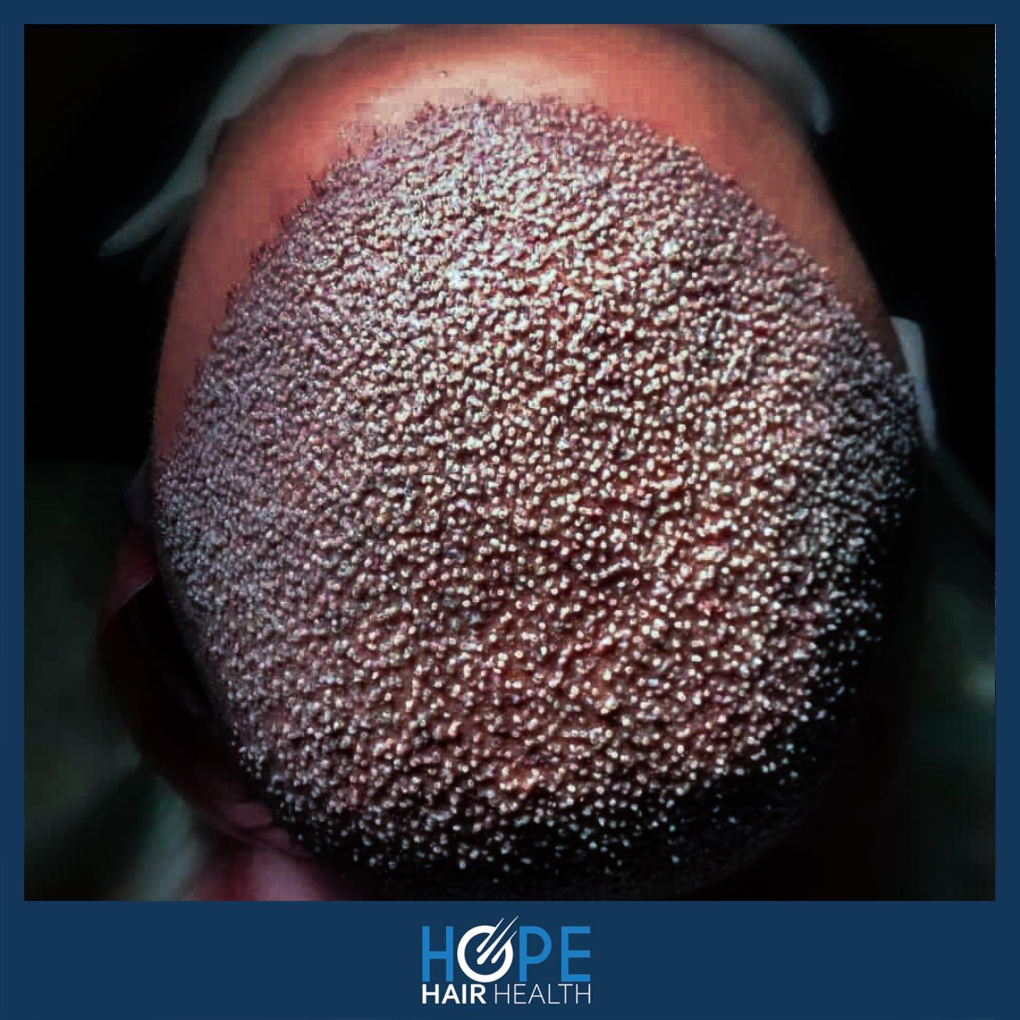 hope hair health - hair transplant results 16