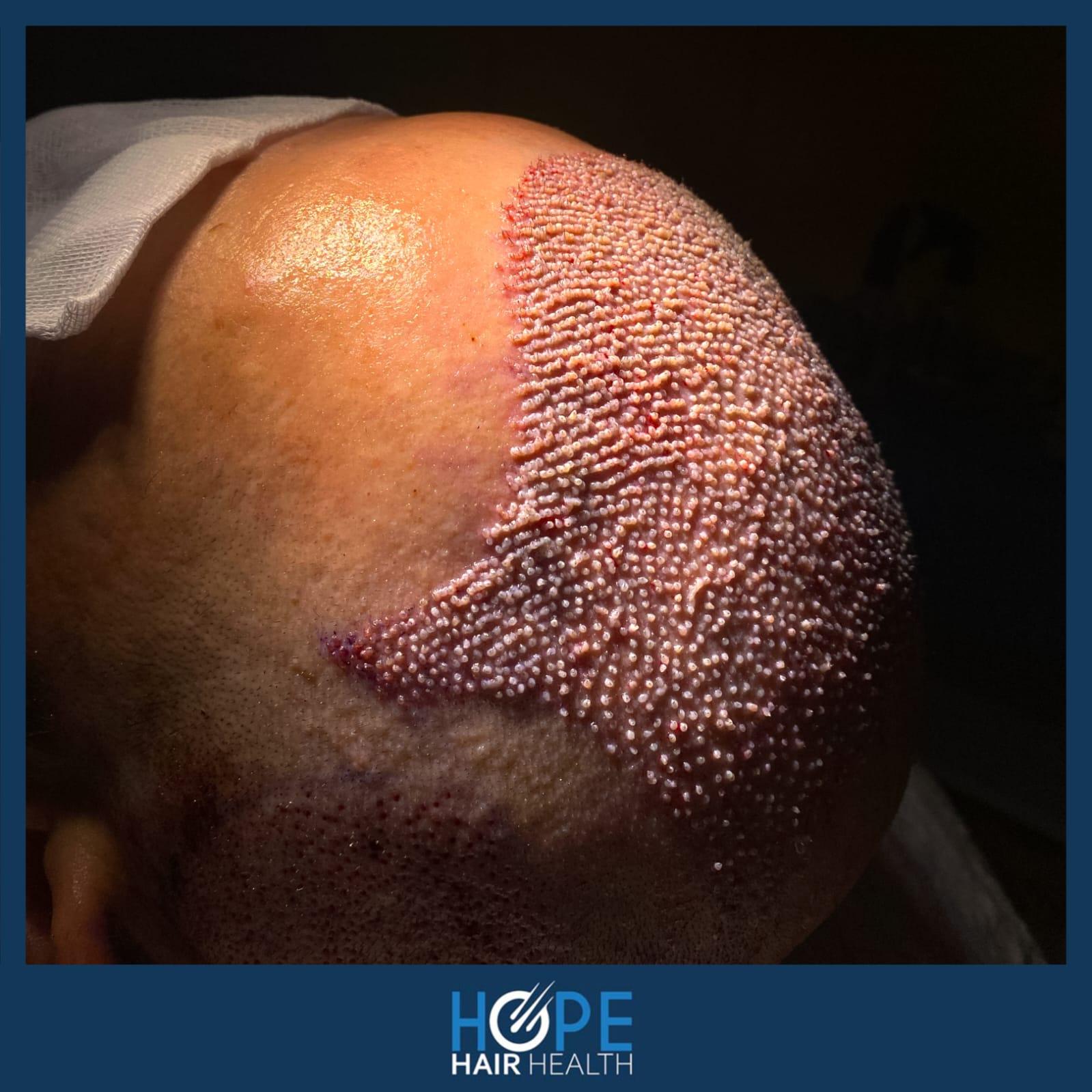 hope hair health - hair transplant results 10