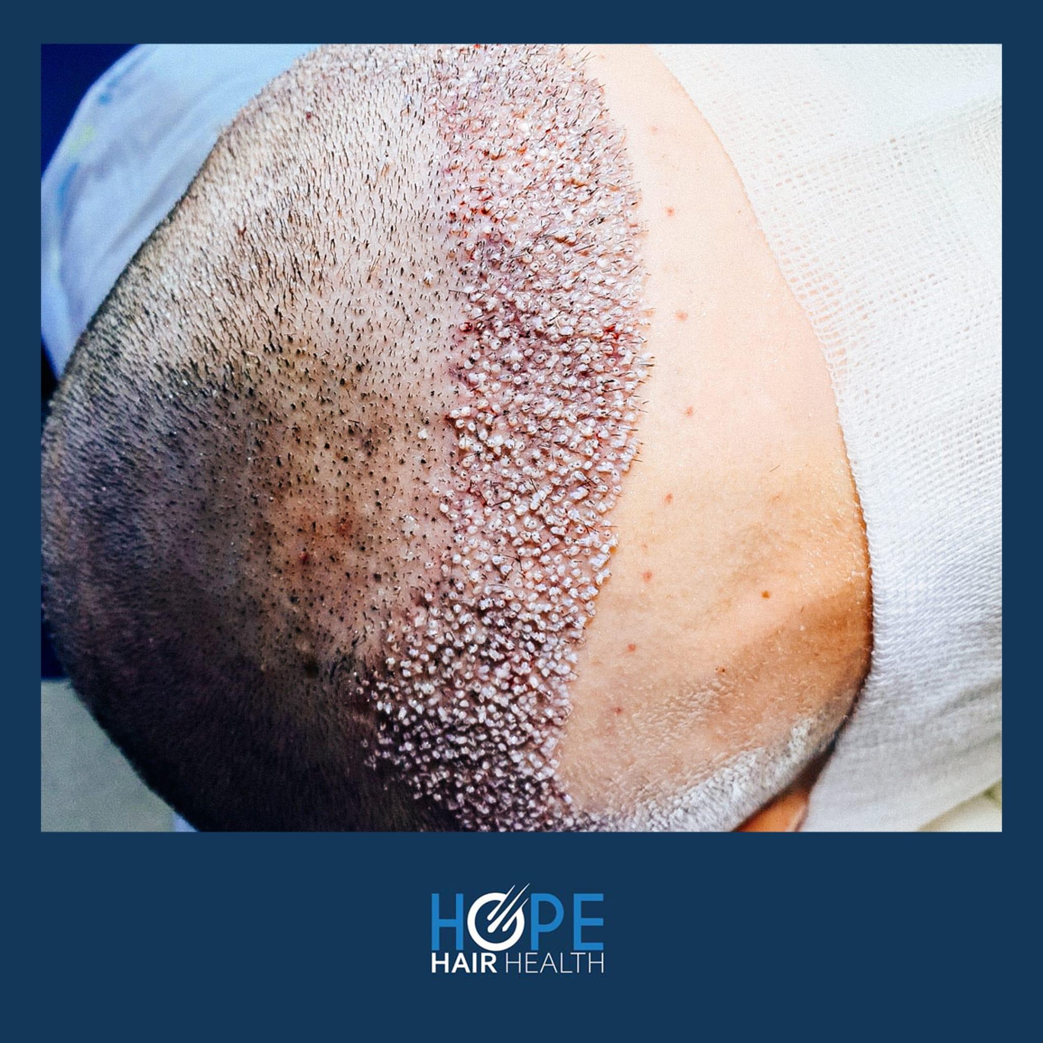 hope hair health - hair transplant results 2