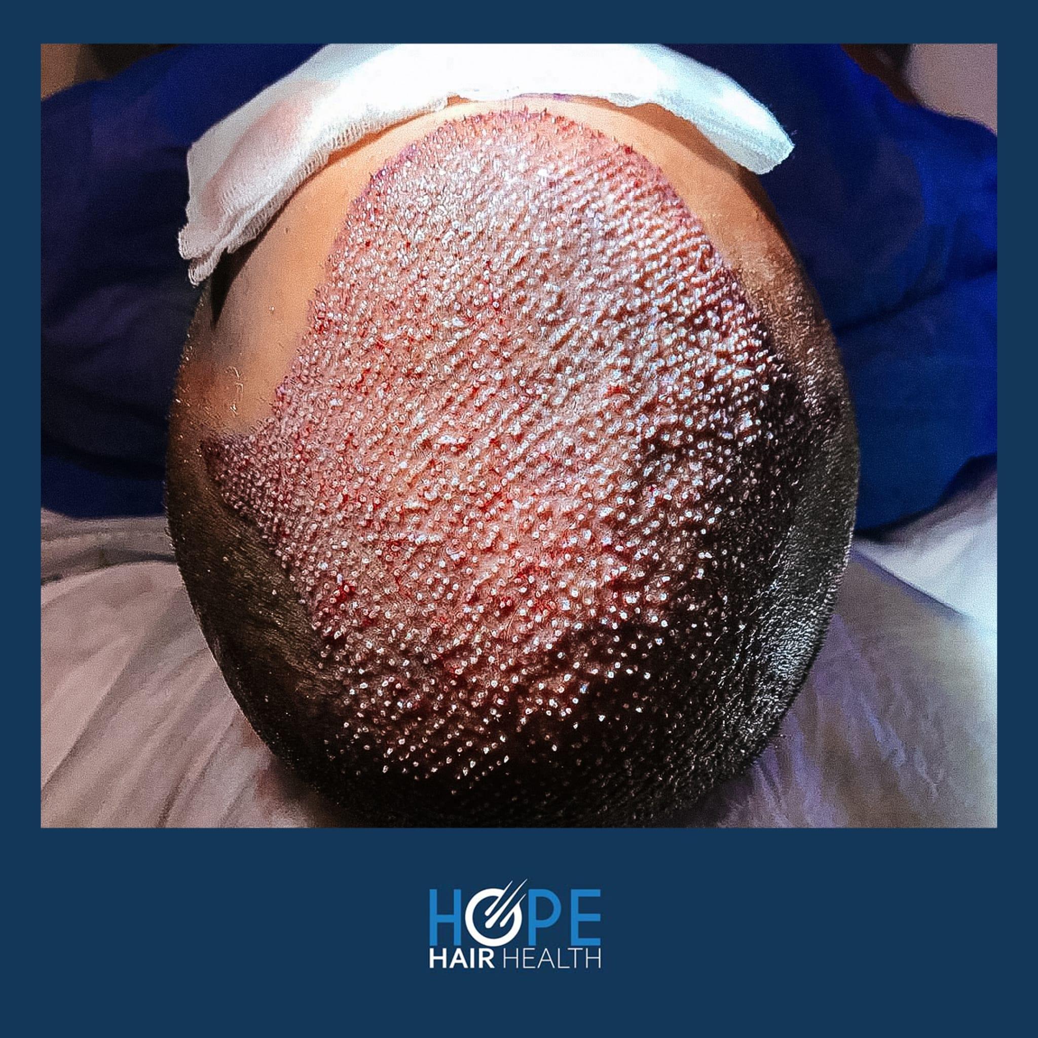 hope hair health - hair transplant results 3