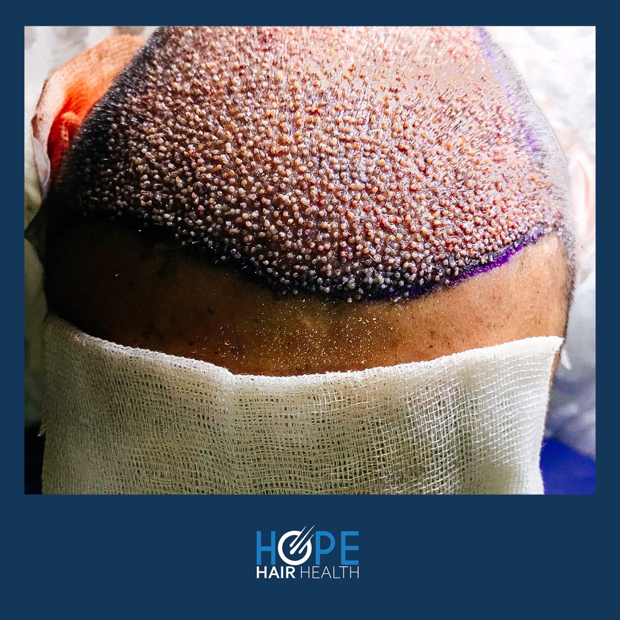 hope hair health - hair transplant results 6