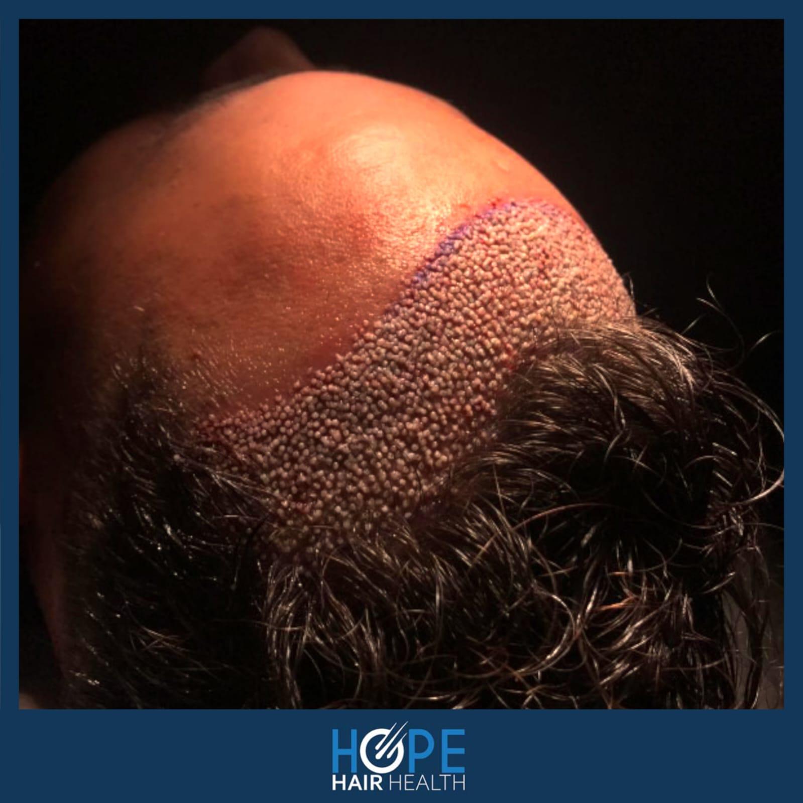 hope hair health - hair transplant results 12