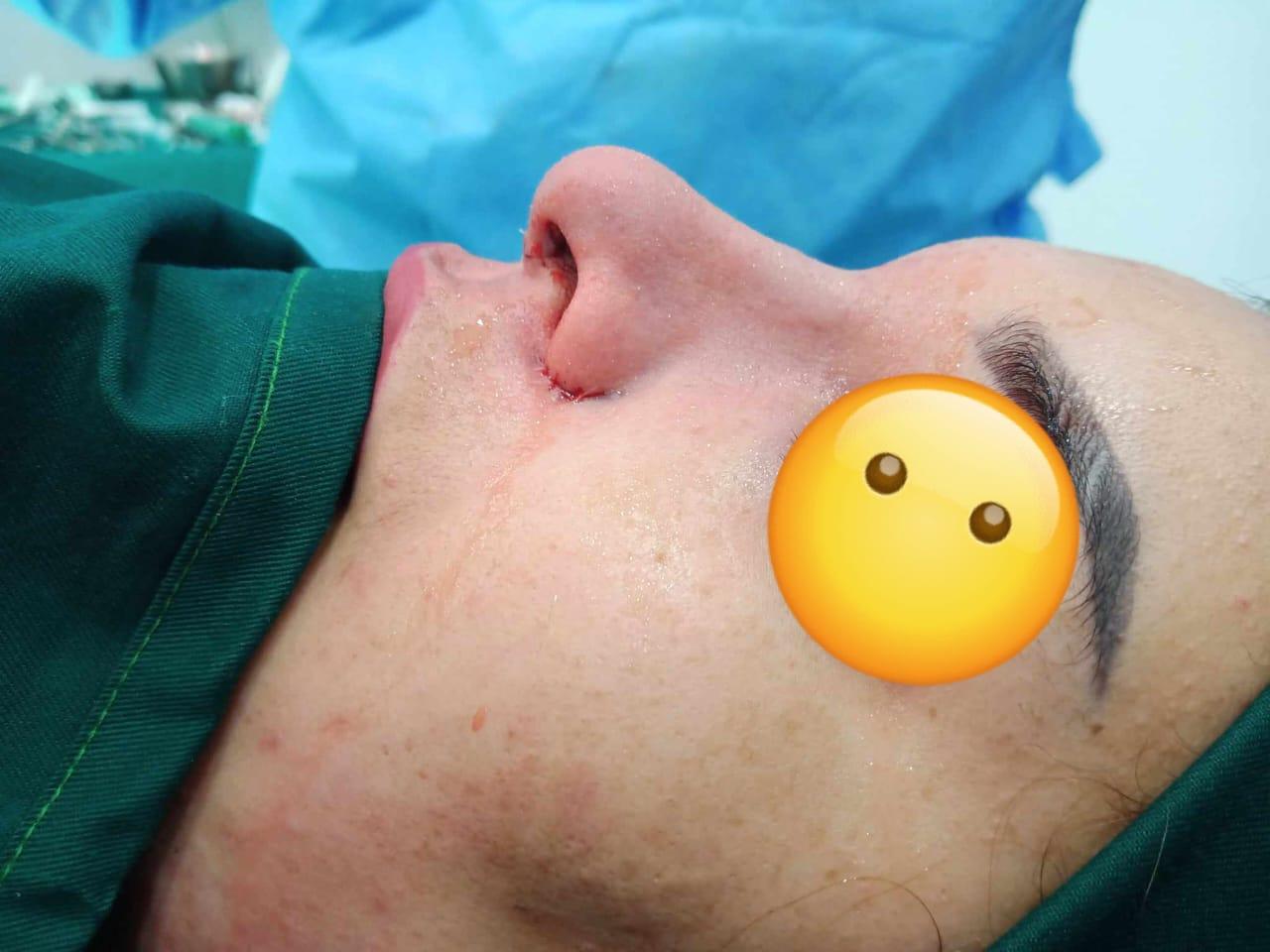 RHINOPLASTIE TUNISIE ZAGHOUAN3