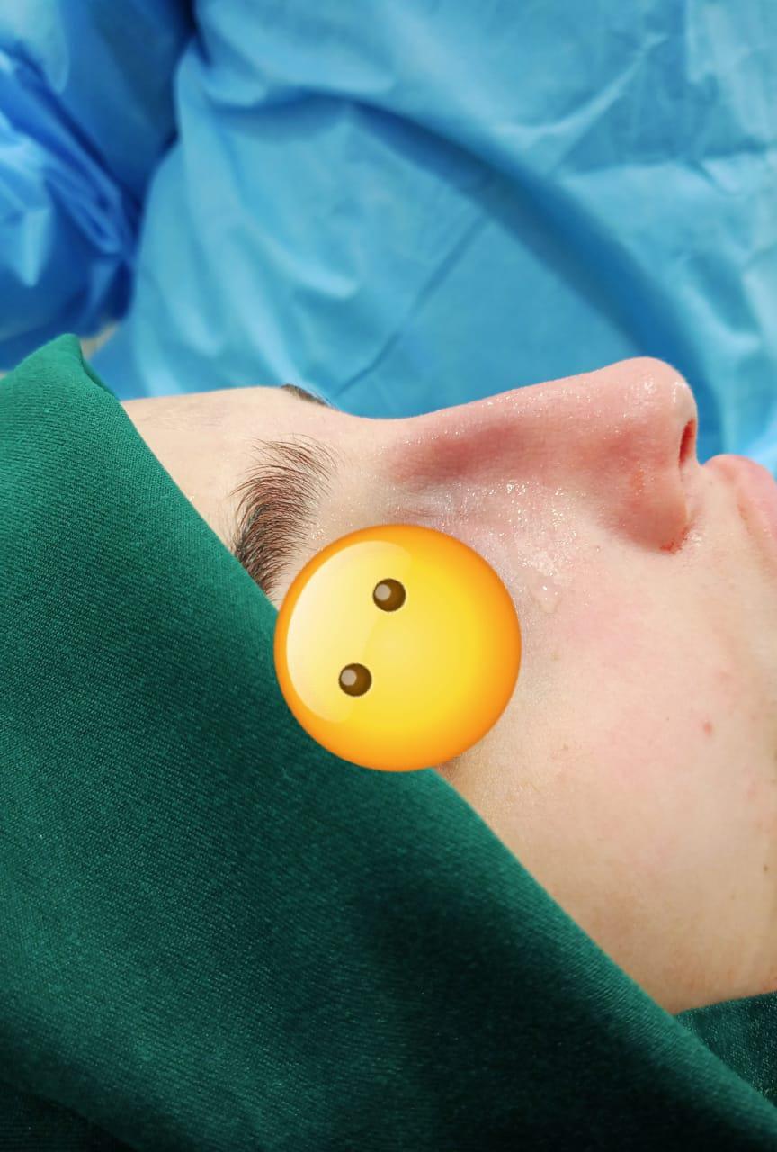 RHINOPLASTIE TUNISIE ZAGHOUAN7