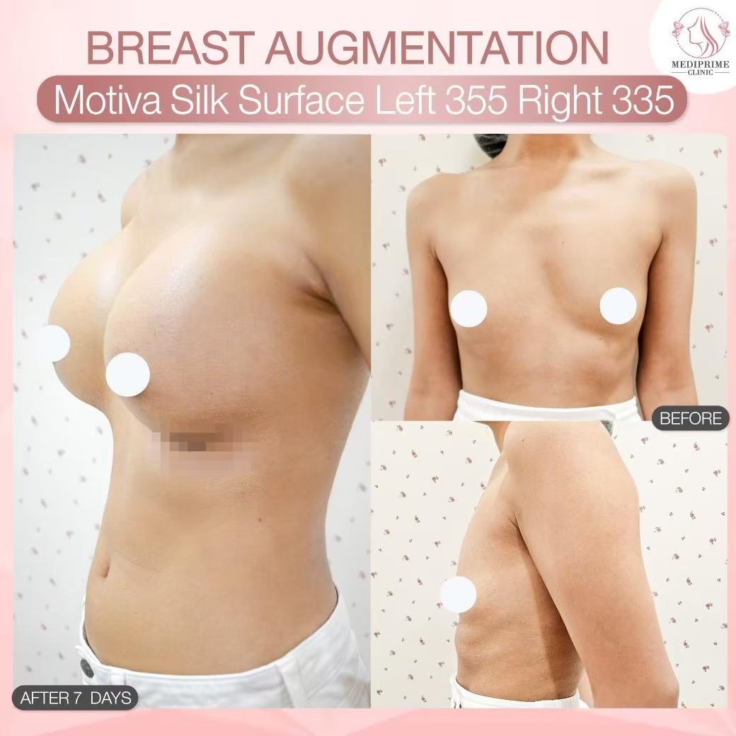 Results breast augmentation Mediprim Clinic Bangkok 9
