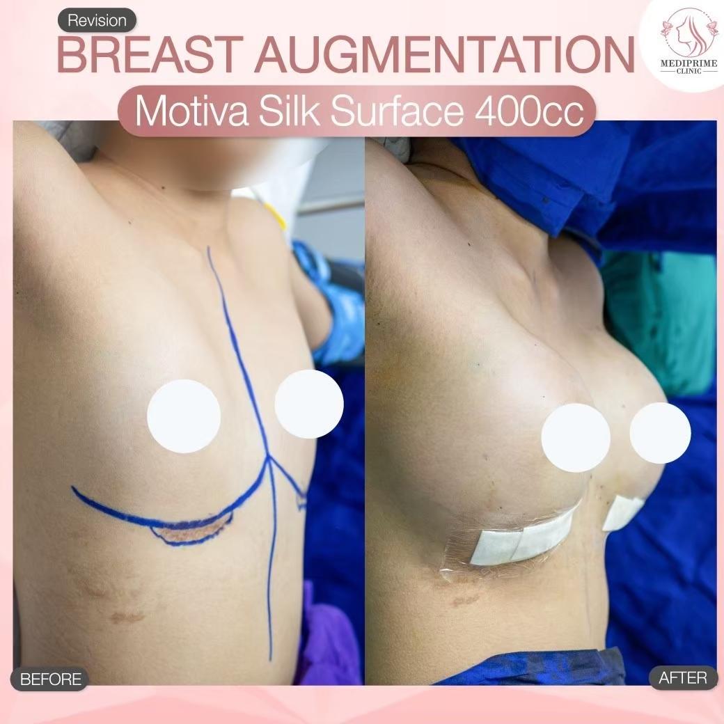 Results breast augmentation Mediprim Clinic Bangkok 7