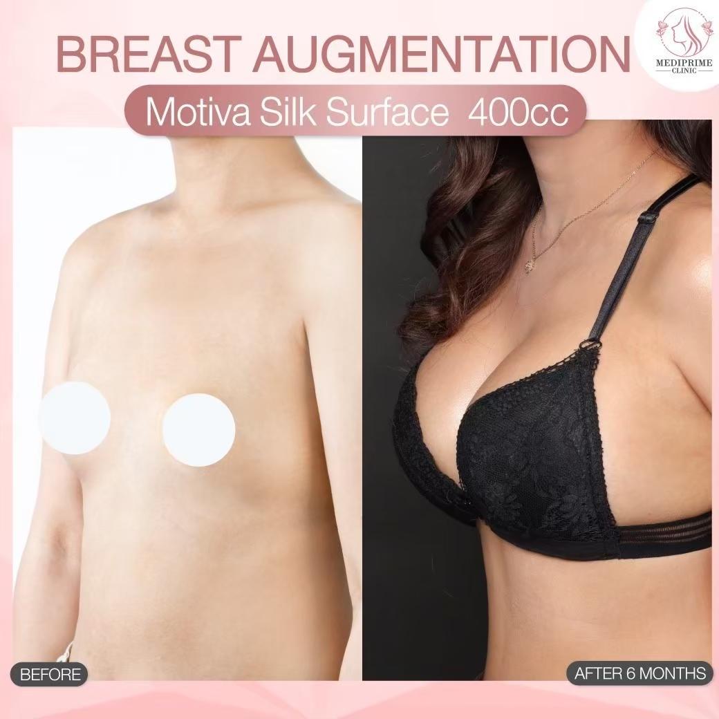 Results breast augmentation Mediprim Clinic Bangkok 2