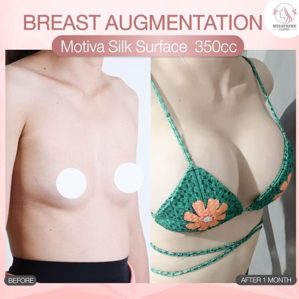 Results breast augmentation Mediprim Clinic Bangkok 3
