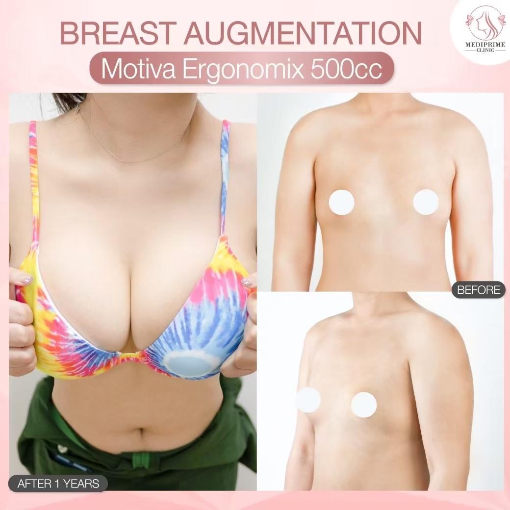 Results breast augmentation Mediprim Clinic Bangkok 1