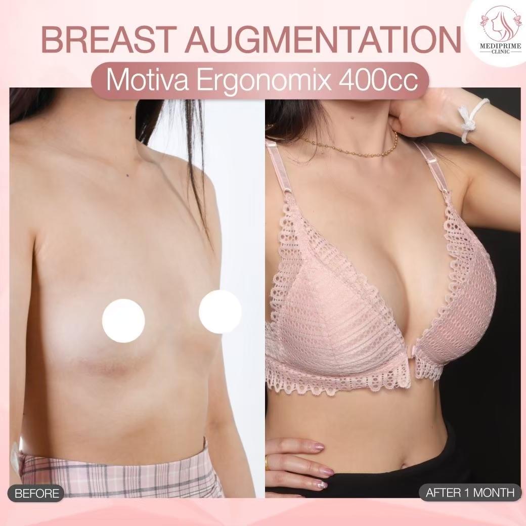 Results breast augmentation Mediprim Clinic Bangkok 10