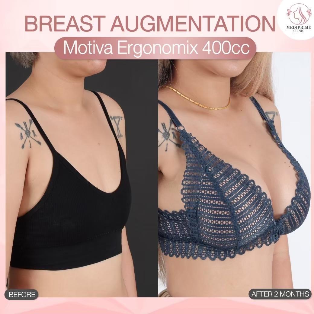 Results breast augmentation Mediprim Clinic Bangkok 8