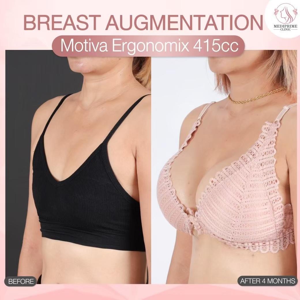Results breast augmentation Mediprim Clinic Bangkok 11