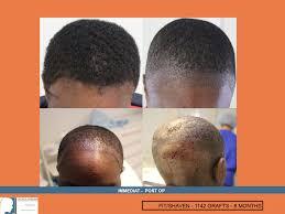 Dr Patrick Mwamba Hair transplant result