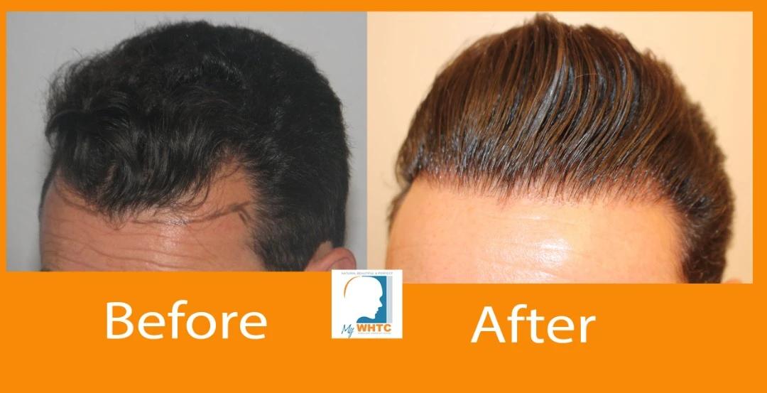 Dr Patrick Mwamba Hair transplant result
